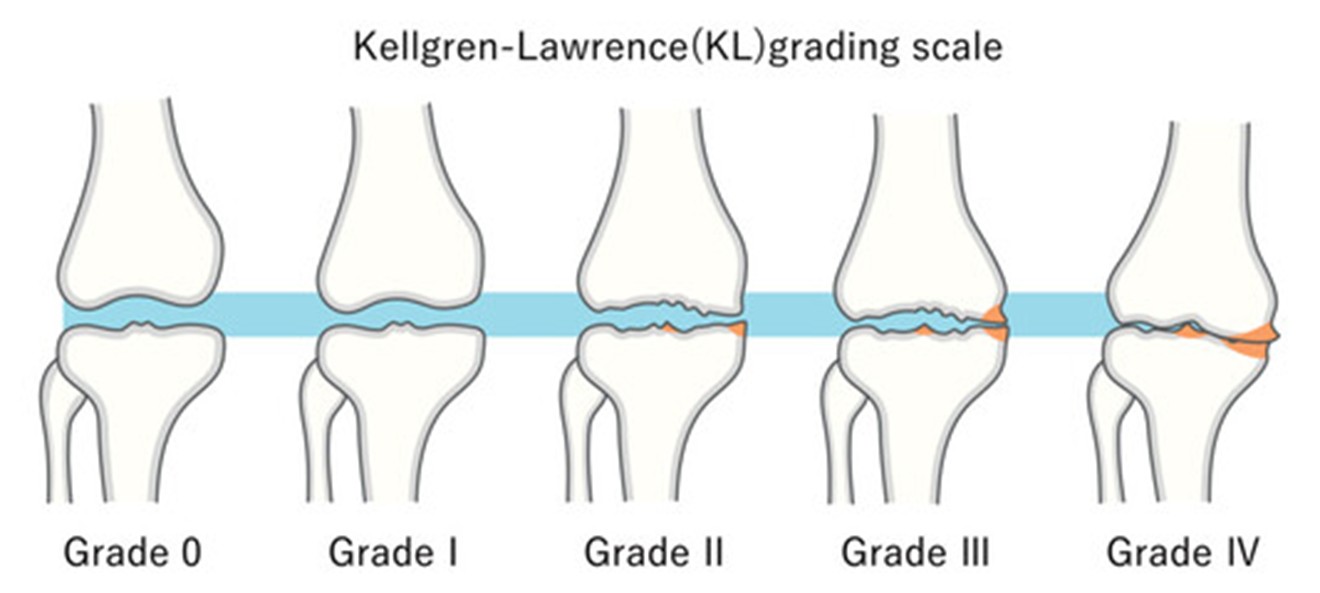 Kellgren-Lawrence 膝關節退化分級圖（Grade 0–4）